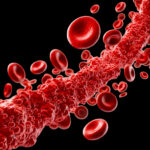 Sickle Cell Anemia