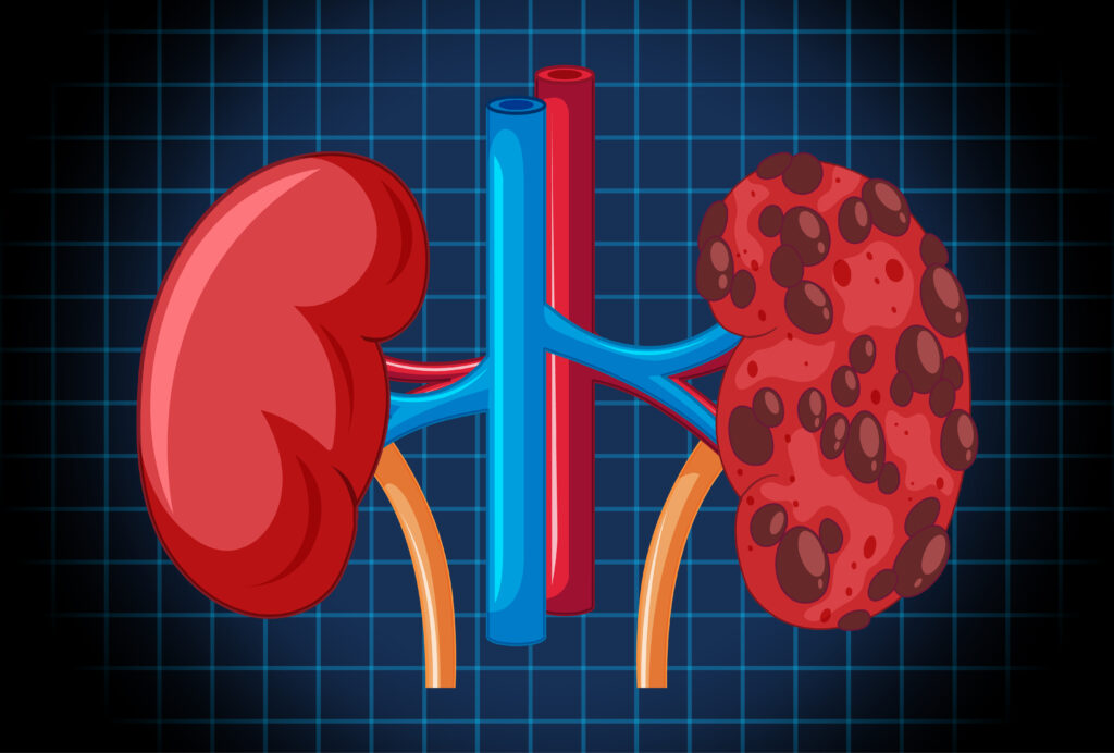 Chronic Kidney Disease